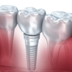 Exploring the Benefits of Dental Implants in Ellisville: Your Comprehensive Guide