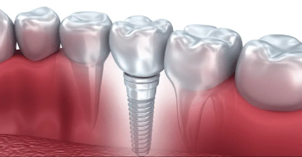 Exploring the Benefits of Dental Implants in Ellisville: Your Comprehensive Guide